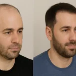 Rediscover Confidence with a Modern Hair Transplant Procedure